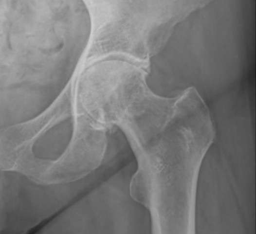 X-Ray of a Hip