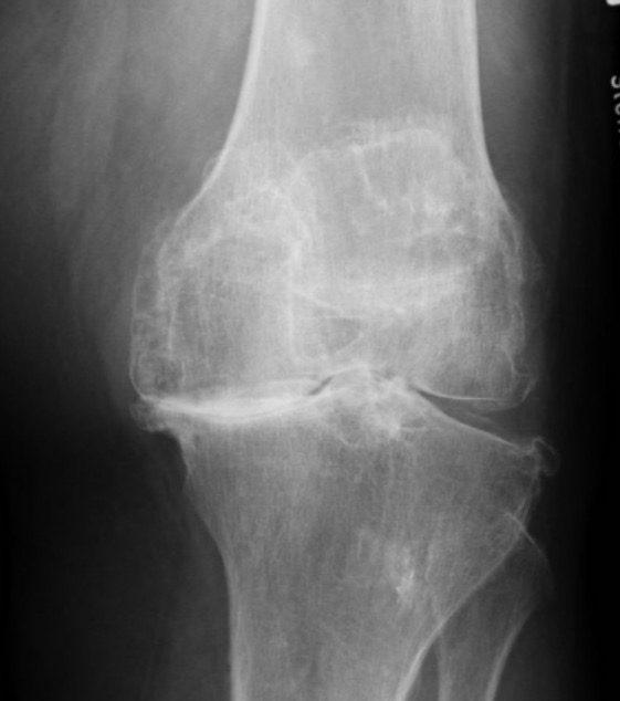 X-Ray of a Knee