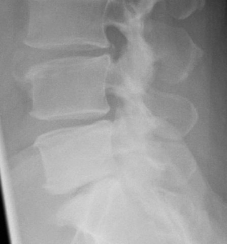 X-Ray of a Spine